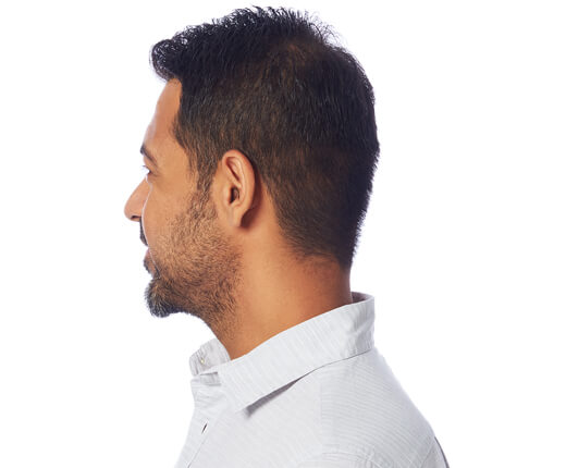 سماعة أذن IIC غير مرئية لضعاف السمع